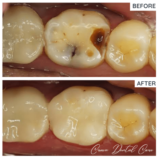 Dental cavity filling using resin composite