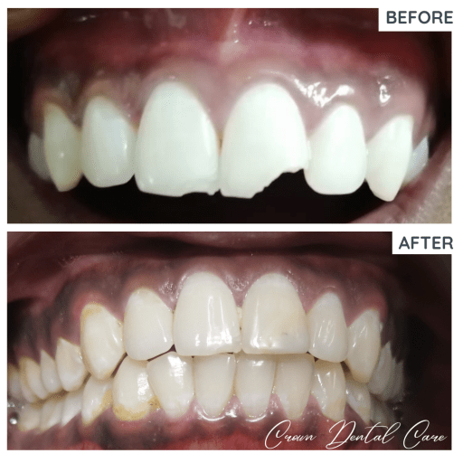 Repair of fractured tooth using composite resin buldup