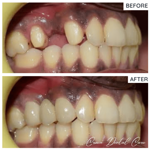 Replacement of a missing tooth using Zirconia bridge